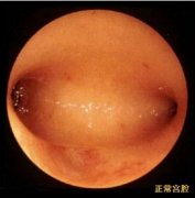 女性宫腔粘连能自然怀孕吗?