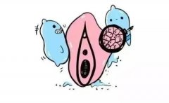 外阴癌能彻底治好吗?外阴癌的治愈率是多少