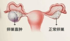 什么卵巢问题会影响女性怀孕?顺利的排卵是怀孕的先决条件