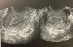 子宫内膜不均匀有强回声怎么回事?真实案例解析