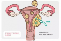 子宫肌瘤来袭，月经会有哪些变化？这些症状需警惕！