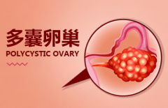 多囊病情“揭秘术”：轻松分辨轻重，知己知彼不迷茫！
