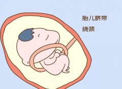 脐带绕颈大揭秘！早知早防，宝贝安全无忧！
