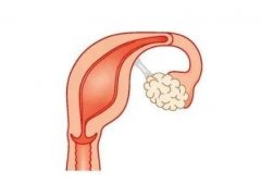 单角子宫4个危害介绍!防治很关键