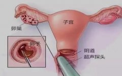 试管卵泡穿刺术需要多少钱，具体费用因人而异