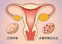 多囊患者做试管优点和缺点是什么?试管前要考虑那些问题