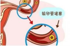 单侧输卵管堵塞不治疗危险吗？有什么办法可以怀孕？