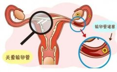 输卵管积水的原因分析!如何规避输卵管积水问题