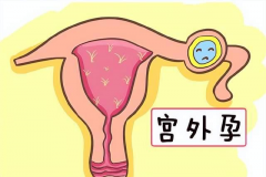 宫外孕探秘：初期症状的“神秘面纱”揭晓！