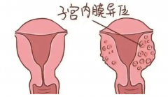 子宫内膜厚达17mm，必须刮宫吗？揭秘刮宫背后的“副作用”真相！