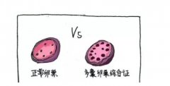 一文了解胖多囊一定要减肥才能怀孕吗？