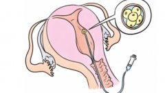 取卵腹水主要表现为卵巢肿大，可以不抽取腹水治疗吗？