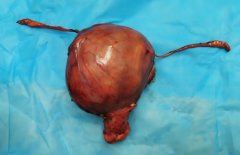 子宫肌瘤术后应该吃什么?子宫肌瘤术后要怎样调理?