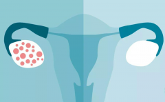 “多囊”逆袭记：试管有望？调理秘籍大公开！