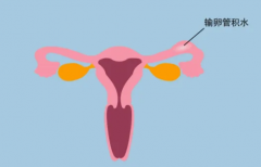 输卵管积水6厘米：病情解读与消除策略