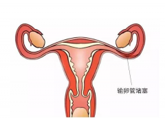 输卵管堵塞，试管受孕仍可行！揭秘其对试管过程的影响与奥秘