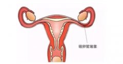 收藏！输卵管堵塞可以用这些方法治疗