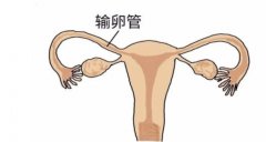输卵管曲想要怀孕，可以采取这些方法