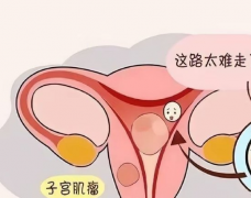 X光是有效的子宫肌瘤诊断工具，不过也有局限性