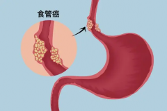 食管癌早期预防与发现秘籍，以及检查大法！