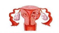 治疗子宫肌瘤用艾灸，艾灸的好处与功效解读