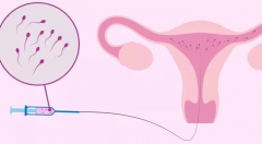 关于人工受精手术，这些常识一定要先了解
