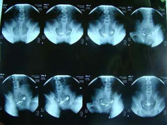 试管的“探路先锋”：输卵管造影，一探究竟要多久？