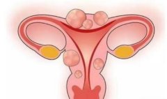 治疗子宫肌瘤的方法有哪些？还需要注意定期复查