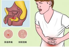尿道毛细管破裂对患者影响较大，三种治疗方法汇总