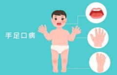 一文了解宝宝手足口病前期症状，及时治疗