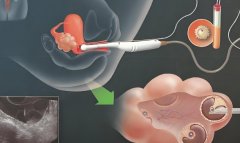 做试管需要准备什么?做试管注意事项有哪些?