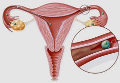 输卵管结核作的妖，试管如何收场?