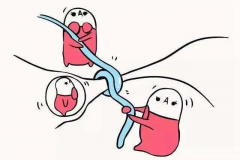 试管积水结扎详细步骤，附试管结扎风险