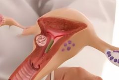 子宫切除后有什么后遗症?大便发黑是怎么回事?