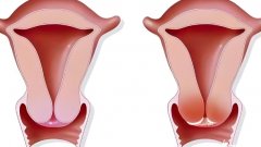 桶状子宫是怎么回事?桶状子宫有什么影响?