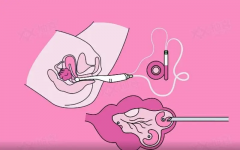 取卵手术可能引发胸腔积液，一般多久能恢复？