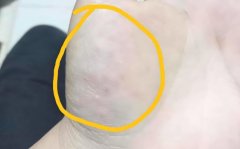 孕期起水泡是什么病?孕期起水泡有什么好的治疗办法?