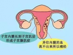 子宫腺肌症能做试管吗？受孕成功率有多高？
