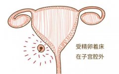 有宫外孕史再做试管，会再次宫外孕吗？