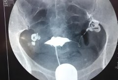 子宫内膜对试管的影响有多大?子宫内膜多厚才算正常?