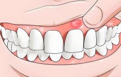 孕期上火大牙牙龈肿痛的病因,缓解孕期上火大牙牙龈肿的办法