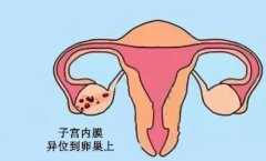 科普篇 | 子宫内膜异位症适合做试管吗？