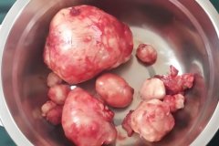 子宫肌瘤如何检查出来?子宫肌瘤有什么影响？