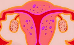 子宫腺肌症怎么办?吃宫瘤消胶囊管用吗?