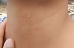 孕妇脖子上有小疙瘩是怎么回事?会影响胎儿吗?