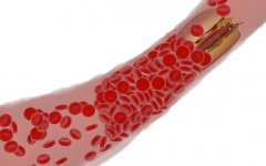 输精管堵塞怎么办?输精管堵塞能试管吗?