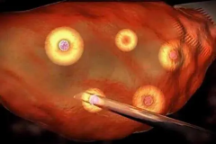 试管取卵痛不痛？权威解答揭晓您的疑问！