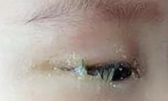 婴儿有眼屎正常吗?婴儿有眼屎怎么办?