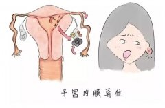 健康科普丨子宫内膜异位症是什么？如何诊断和治疗？