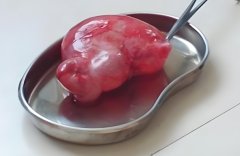 巧克力囊肿可以试管吗?如何处理患有巧克力囊肿?